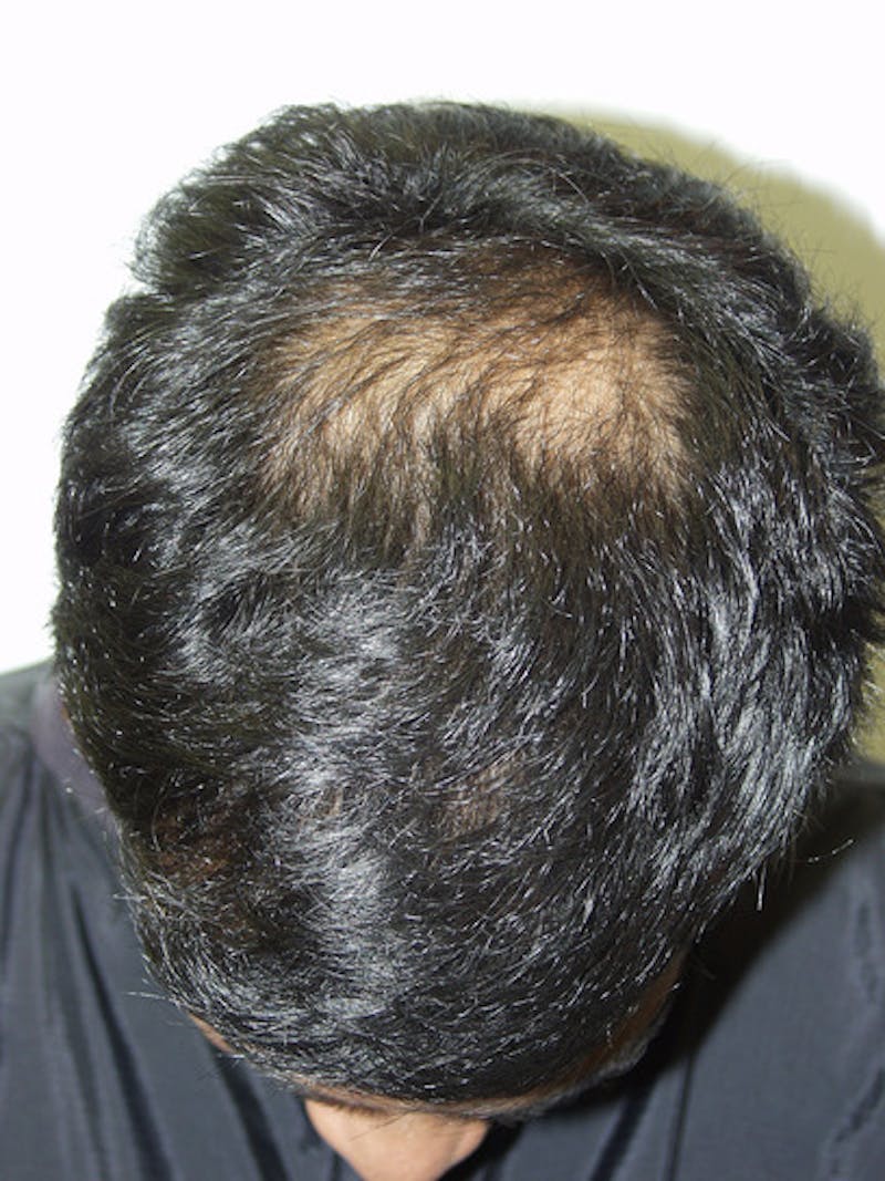 Hair Restoration for Men Before & After Gallery - Patient 404555 - Image 3