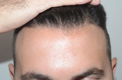 Hair Restoration for Men Before & After Gallery - Patient 173444 - Image 2