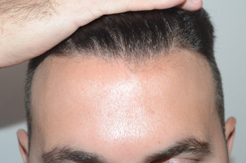 Hair Restoration for Men Before & After Gallery - Patient 205933 - Image 2