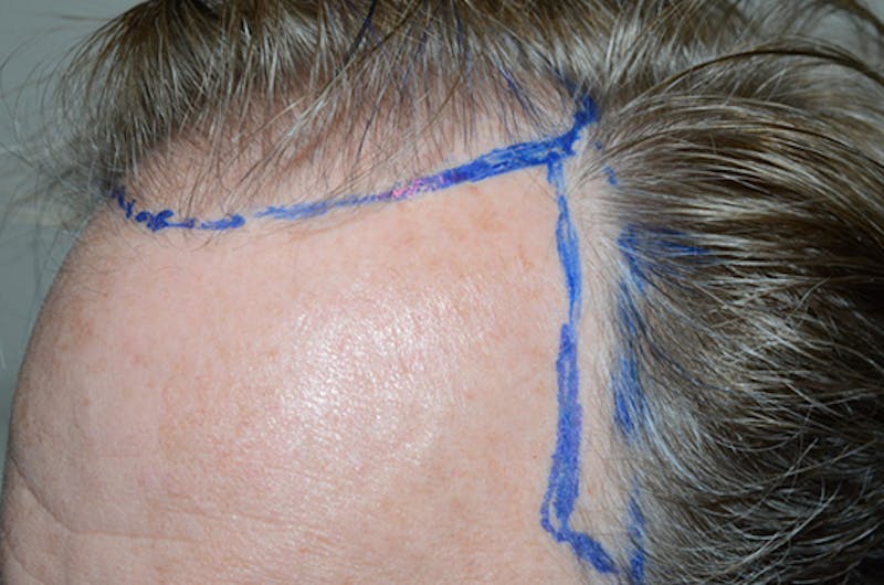 Hair Restoration for Men Before & After Gallery - Patient 166834 - Image 1