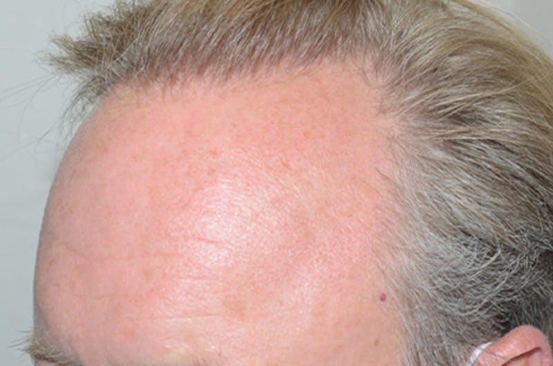 Hair Restoration for Men Before & After Gallery - Patient 166834 - Image 2