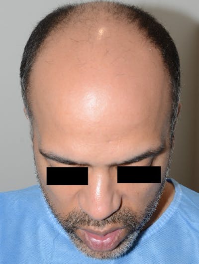 Hair Restoration for Men Before & After Gallery - Patient 810774 - Image 1