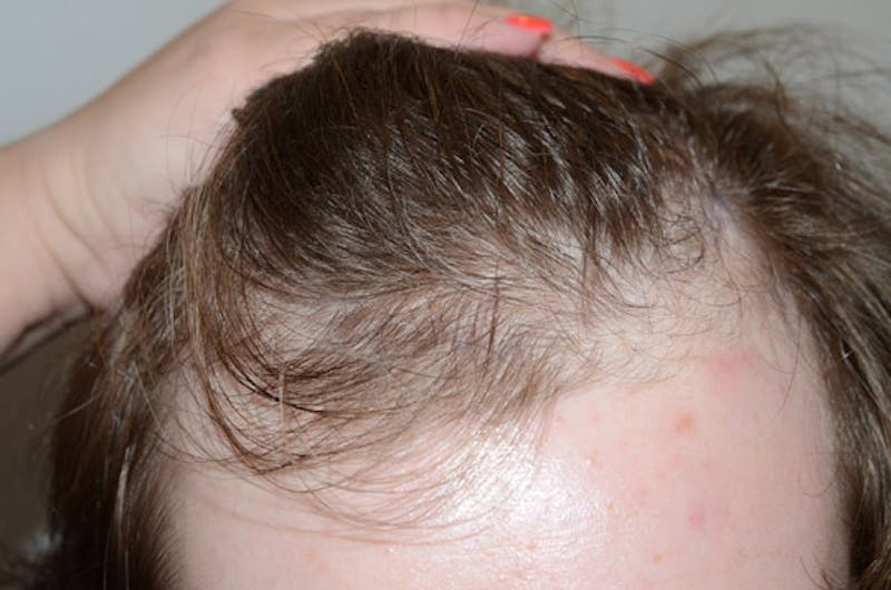 Hair Restoration for Men Before & After Gallery - Patient 587351 - Image 1