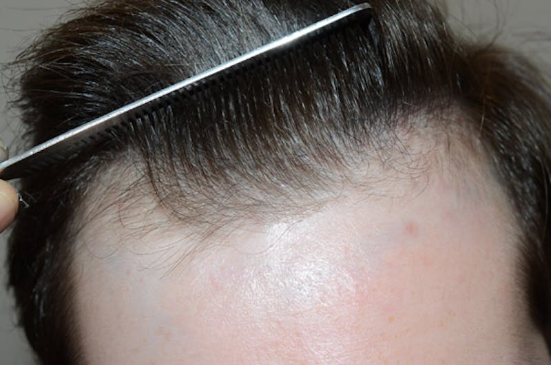 Hair Restoration for Men Before & After Gallery - Patient 587351 - Image 2