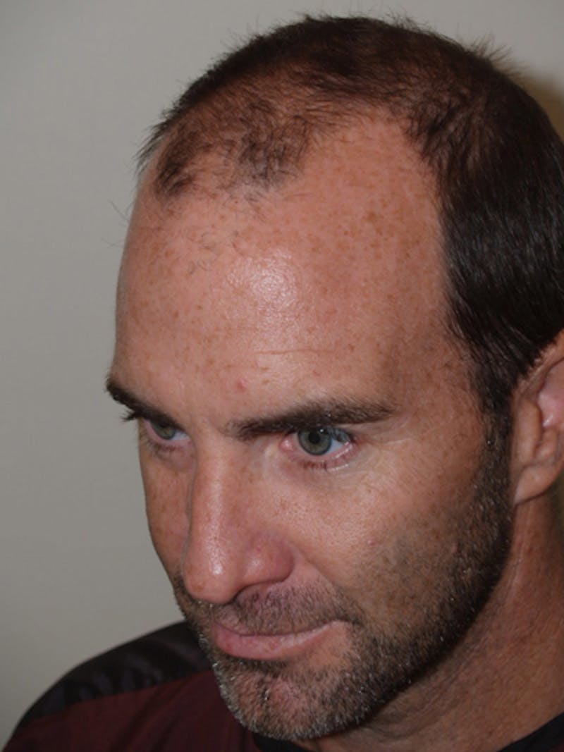 Hair Restoration for Men Before & After Gallery - Patient 230810 - Image 5