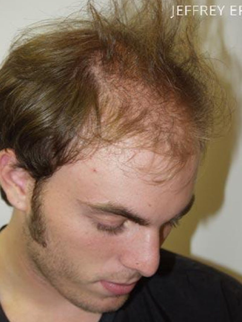 Hair Restoration for Men Before & After Gallery - Patient 247230 - Image 3