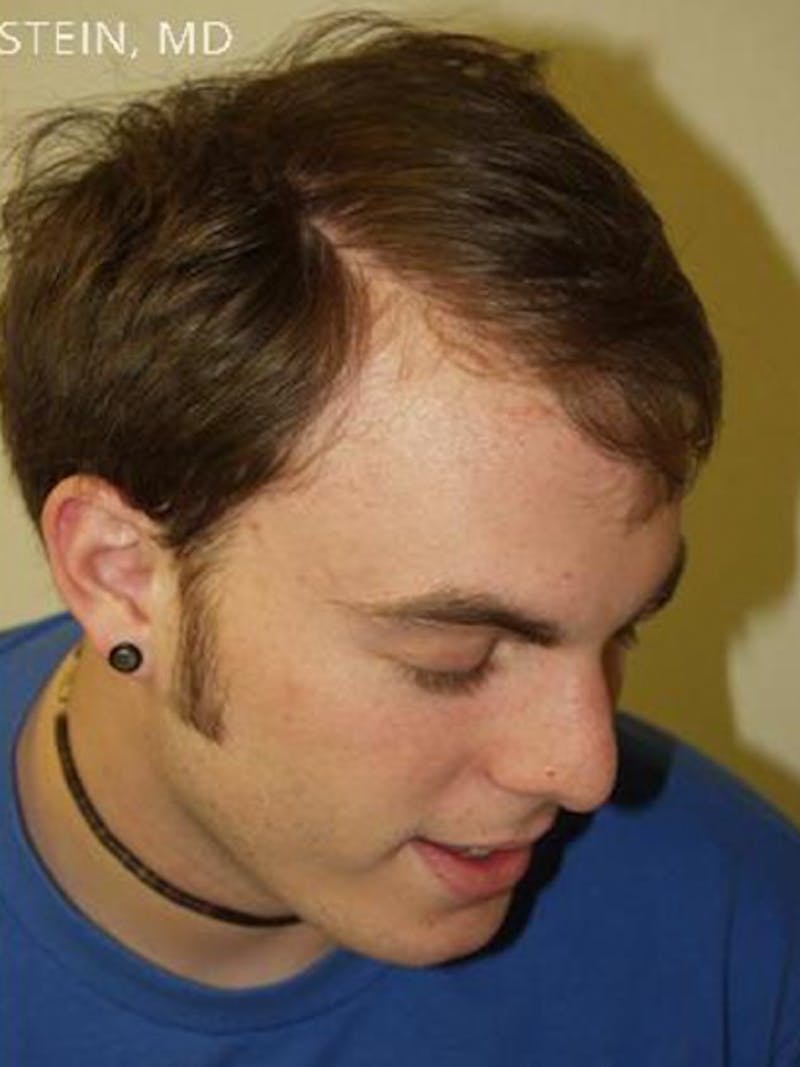 Hair Restoration for Men Before & After Gallery - Patient 247230 - Image 4