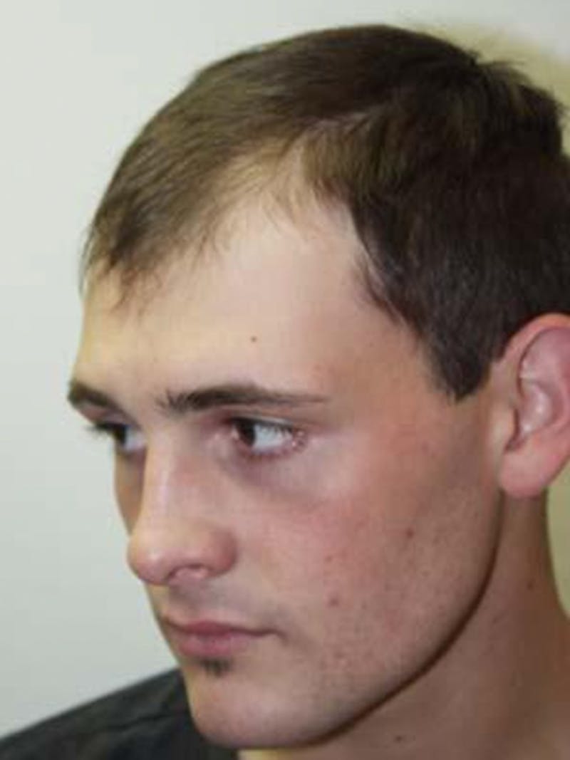 Hair Restoration for Men Before & After Gallery - Patient 331853 - Image 3