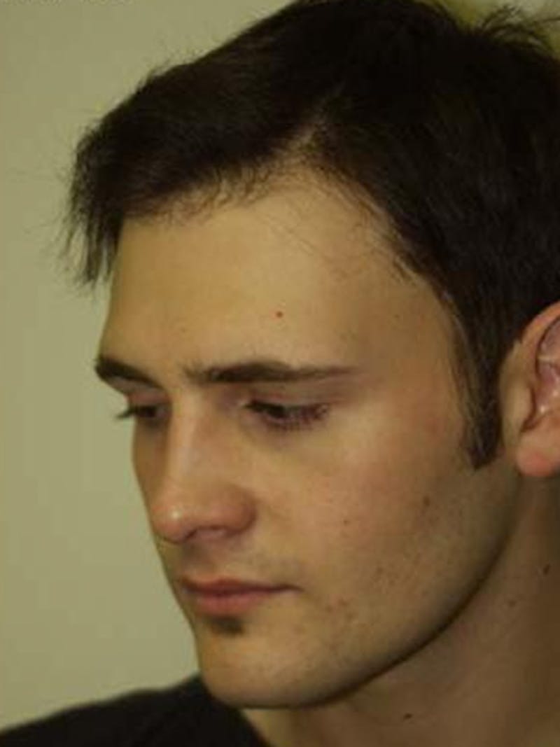 Hair Restoration for Men Before & After Gallery - Patient 331853 - Image 4