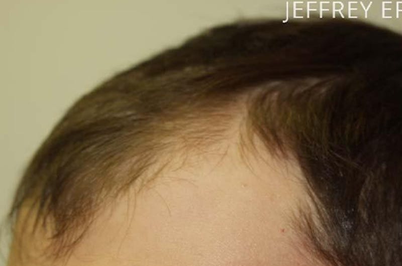 Hair Restoration for Men Before & After Gallery - Patient 331853 - Image 5