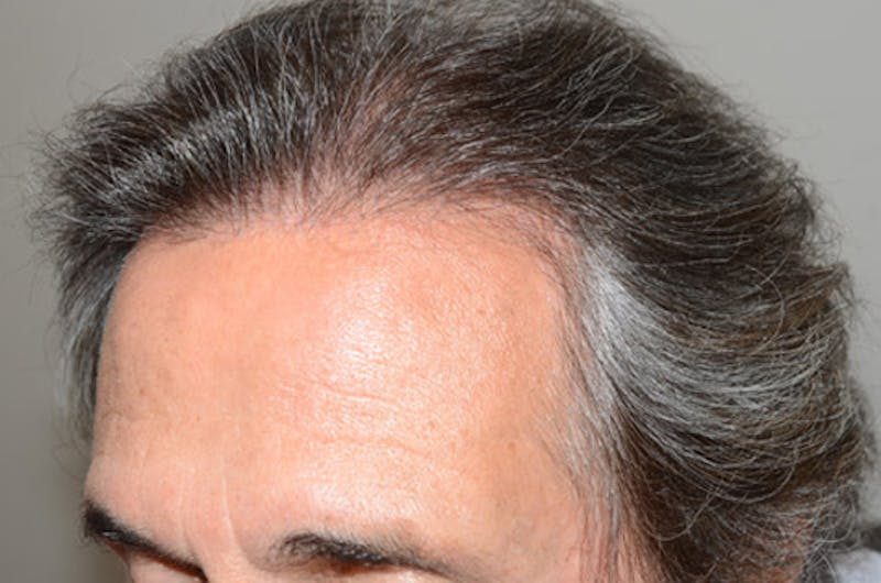 Hair Restoration for Men Before & After Gallery - Patient 633185 - Image 4