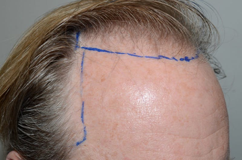 Hair Restoration for Men Before & After Gallery - Patient 166834 - Image 3