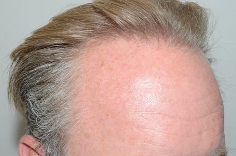 Hair Restoration for Men Before & After Gallery - Patient 166834 - Image 4