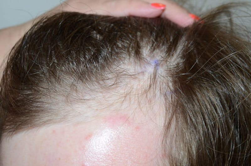 Hair Restoration for Men Before & After Gallery - Patient 587351 - Image 3