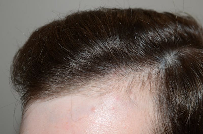 Hair Restoration for Men Before & After Gallery - Patient 587351 - Image 4