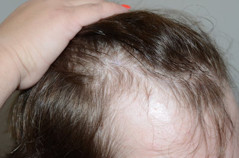 Hair Restoration for Men Before & After Gallery - Patient 587351 - Image 5