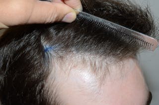 Hair Restoration for Men Before & After Gallery - Patient 587351 - Image 6