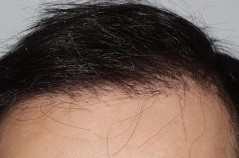 Hair Restoration for Men Before & After Gallery - Patient 100068 - Image 3