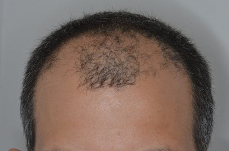 Hair Restoration for Men Before & After Gallery - Patient 146369 - Image 3