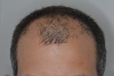 Hair Restoration for Men Before & After Gallery - Patient 249273 - Image 1