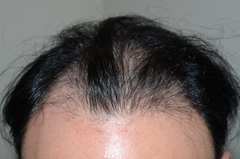 Hair Restoration for Men Before & After Gallery - Patient 947480 - Image 7