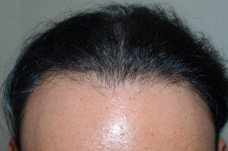 Hair Restoration for Men Before & After Gallery - Patient 947480 - Image 8