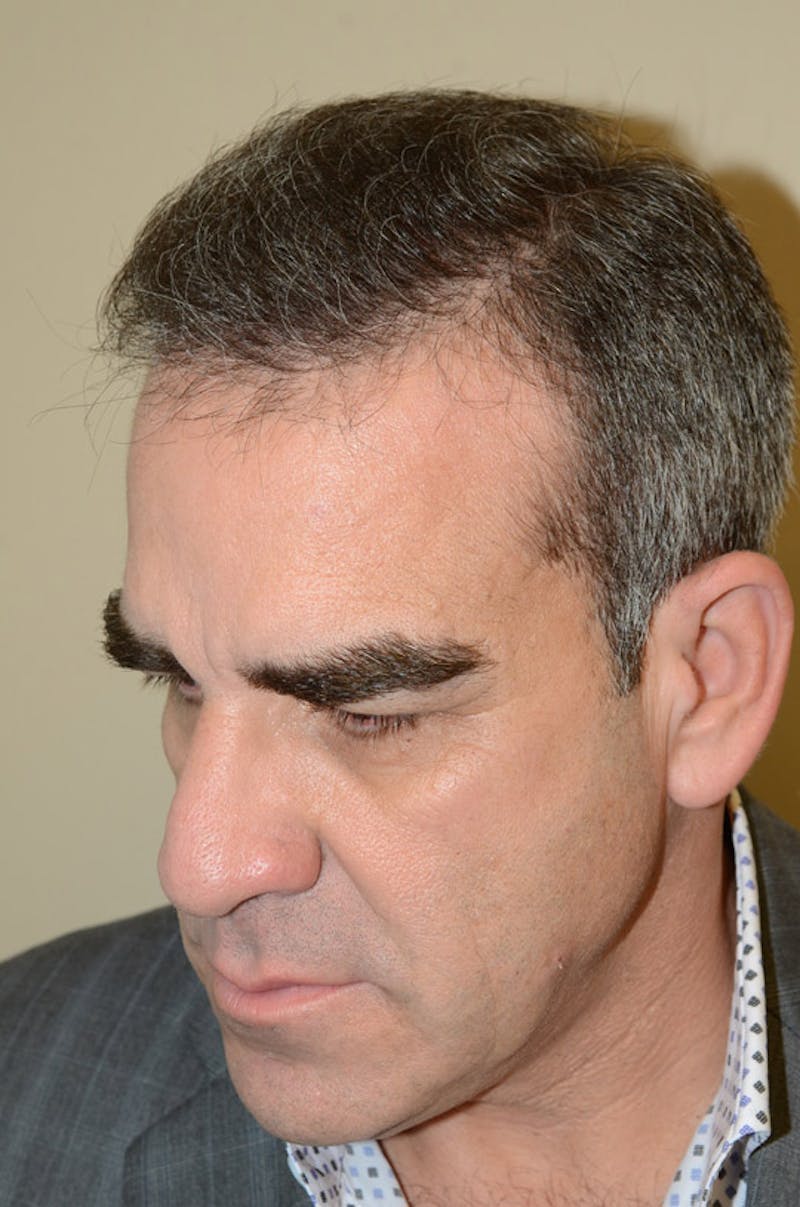 Hair Restoration for Men Before & After Gallery - Patient 105497 - Image 4