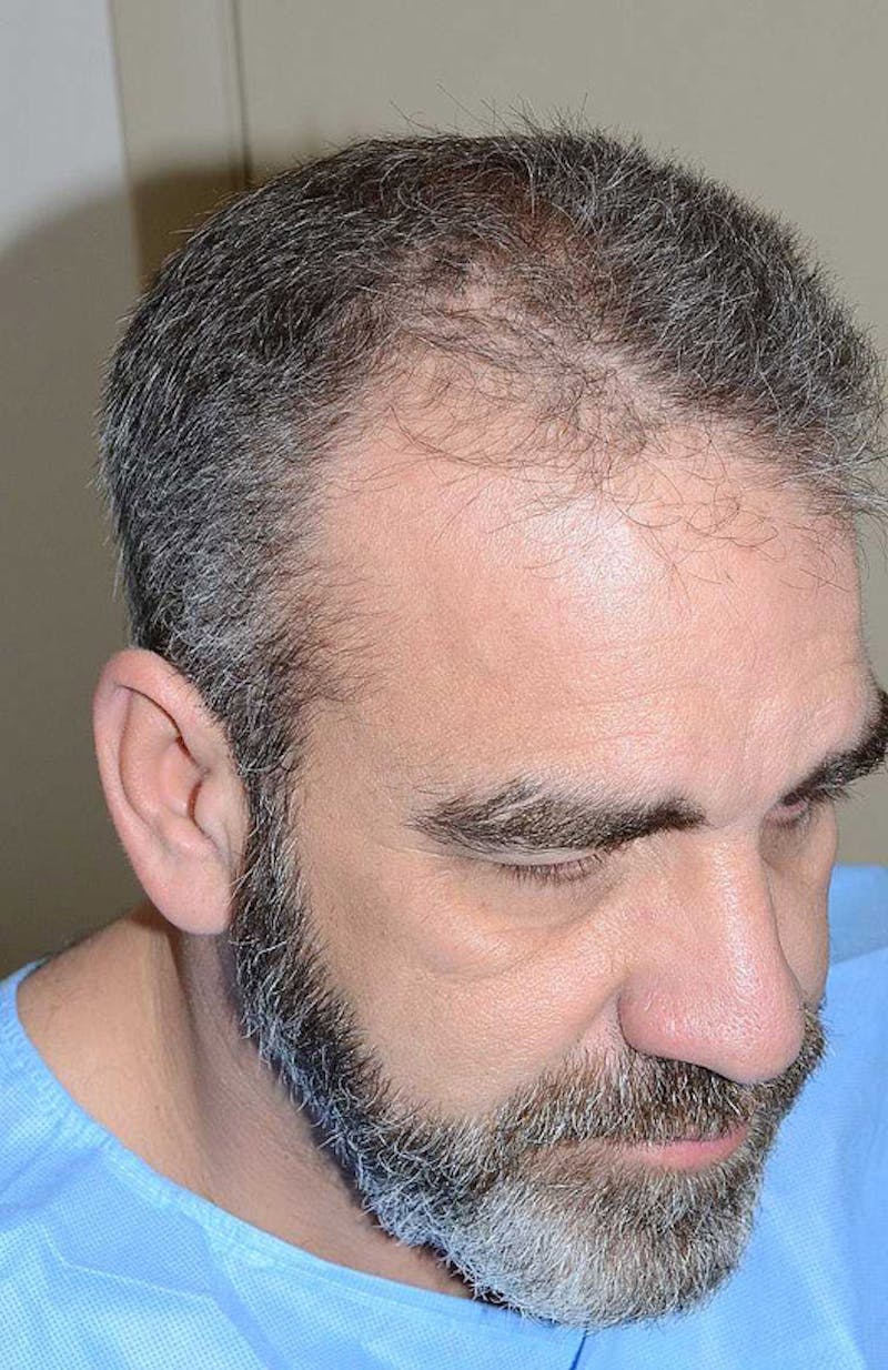 Hair Restoration for Men Before & After Gallery - Patient 105497 - Image 5