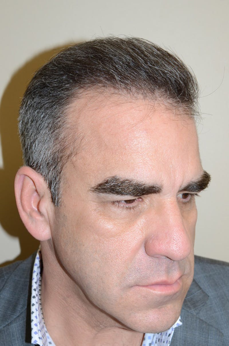 Hair Restoration for Men Before & After Gallery - Patient 105497 - Image 6