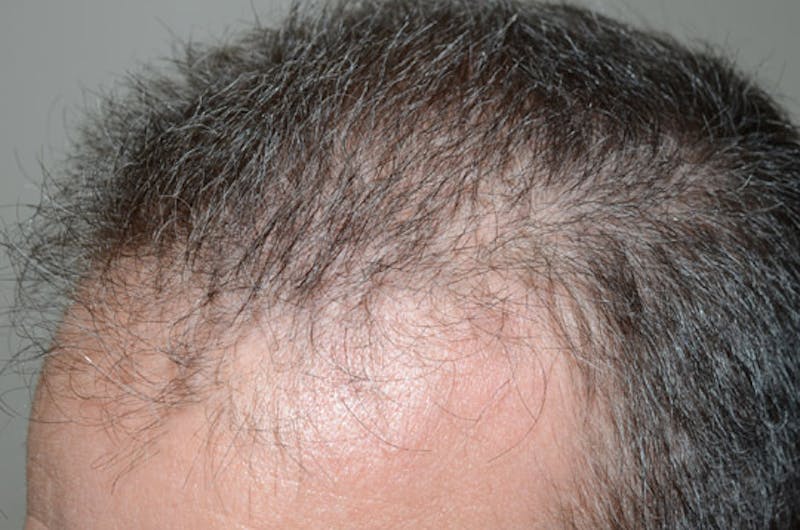 Hair Restoration for Men Before & After Gallery - Patient 105497 - Image 7