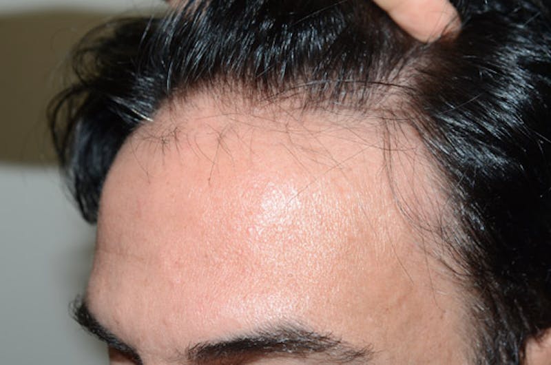 Hair Restoration for Men Before & After Gallery - Patient 400443 - Image 3