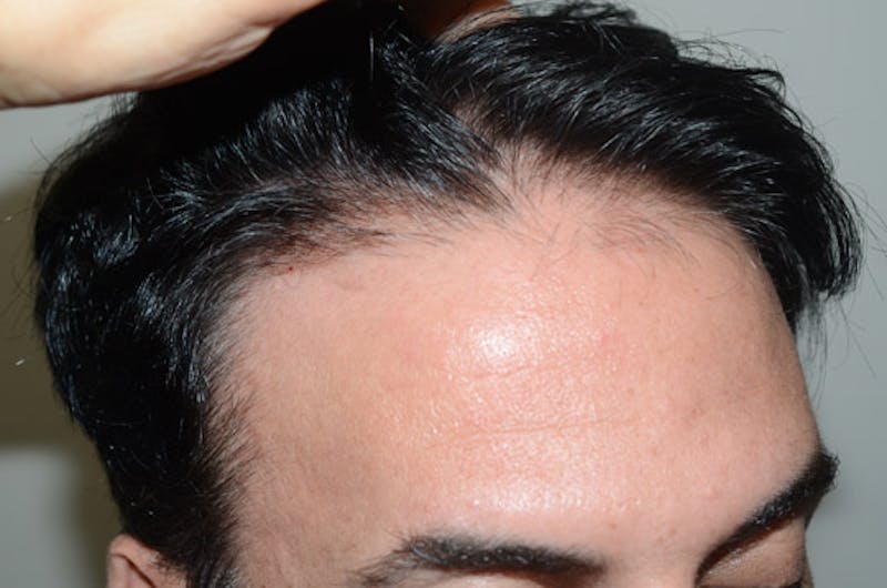 Hair Restoration for Men Before & After Gallery - Patient 400443 - Image 5