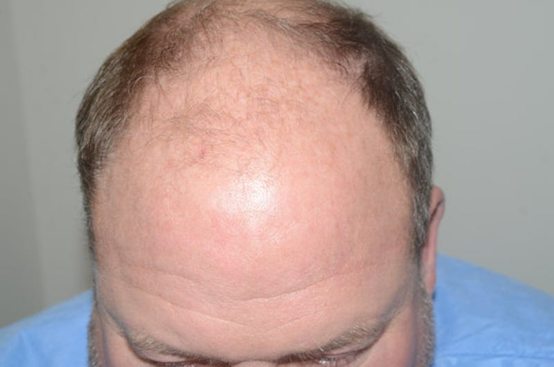 Hair Restoration for Men Before & After Gallery - Patient 257665 - Image 3