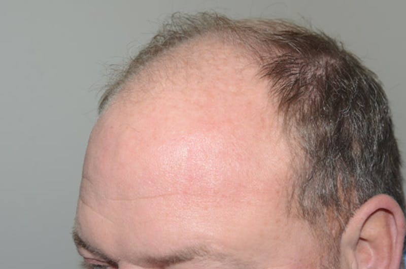 Hair Restoration for Men Before & After Gallery - Patient 257665 - Image 5