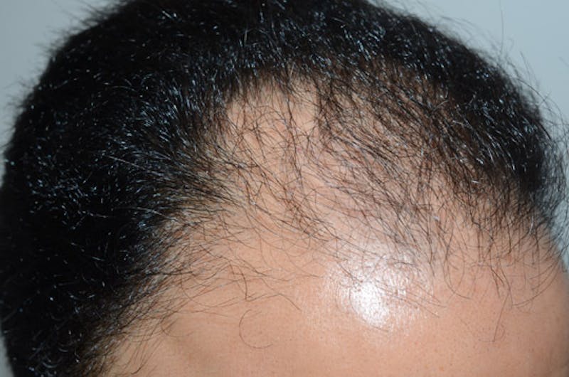 Hair Restoration for Men Before & After Gallery - Patient 203144 - Image 3