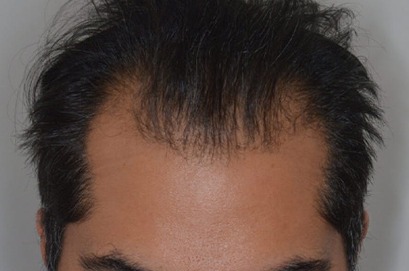 Hair Restoration for Men Before & After Gallery - Patient 374428 - Image 1