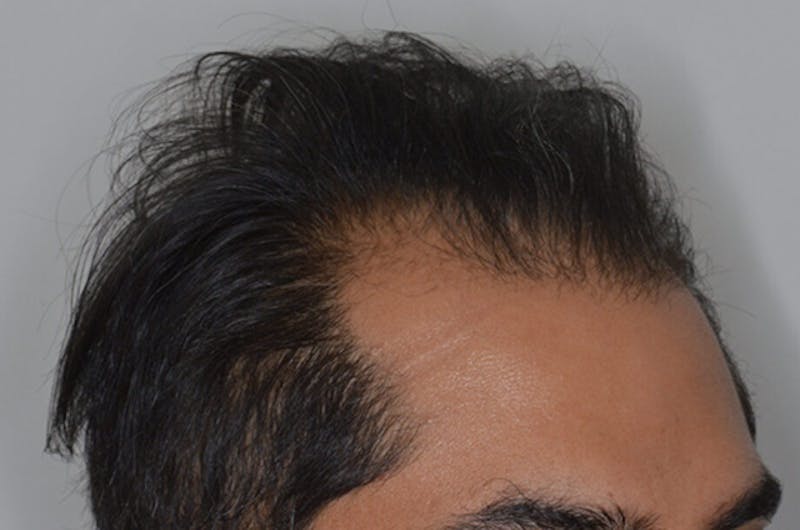 Hair Restoration for Men Before & After Gallery - Patient 374428 - Image 3