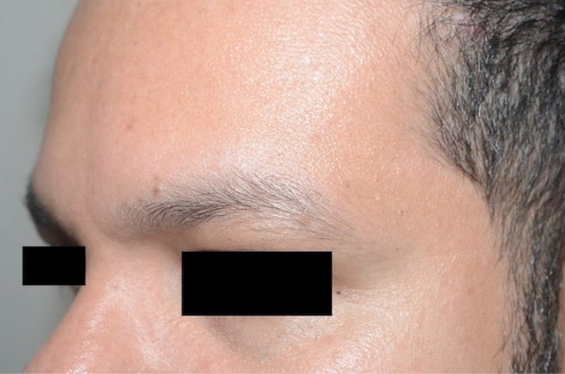 Eyebrow Transplantation Before & After Gallery - Patient 275303 - Image 3