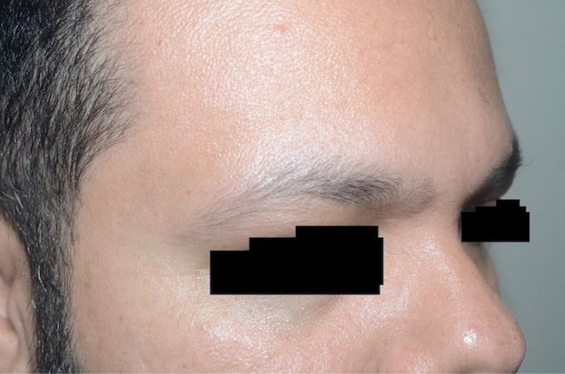 Eyebrow Transplantation Before & After Gallery - Patient 275303 - Image 5