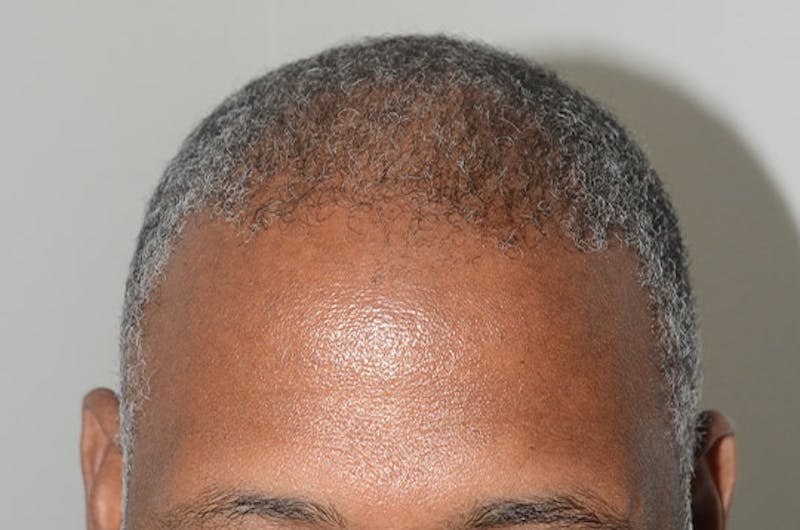 Hair Restoration for Men Before & After Gallery - Patient 239869 - Image 4