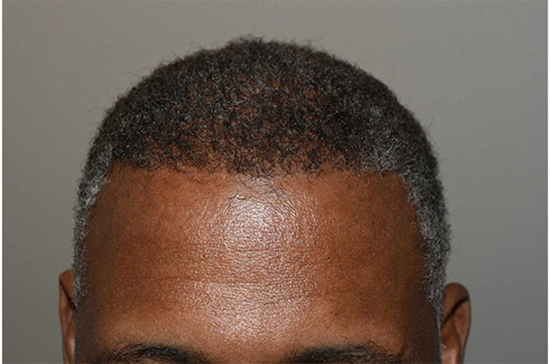 Hair Restoration for Men Before & After Gallery - Patient 790477 - Image 4