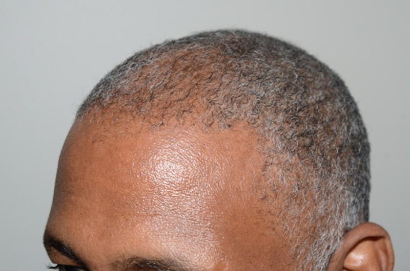 Hair Restoration for Men Before & After Gallery - Patient 239869 - Image 7