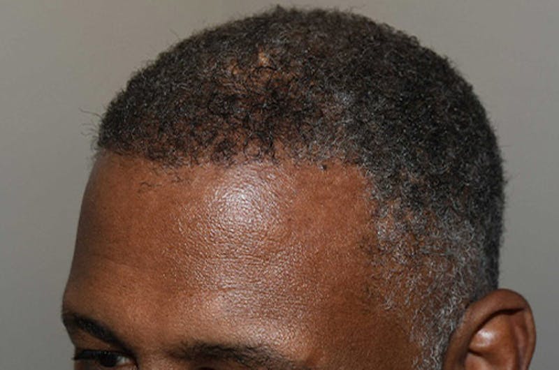 Hair Restoration for Men Before & After Gallery - Patient 790477 - Image 6