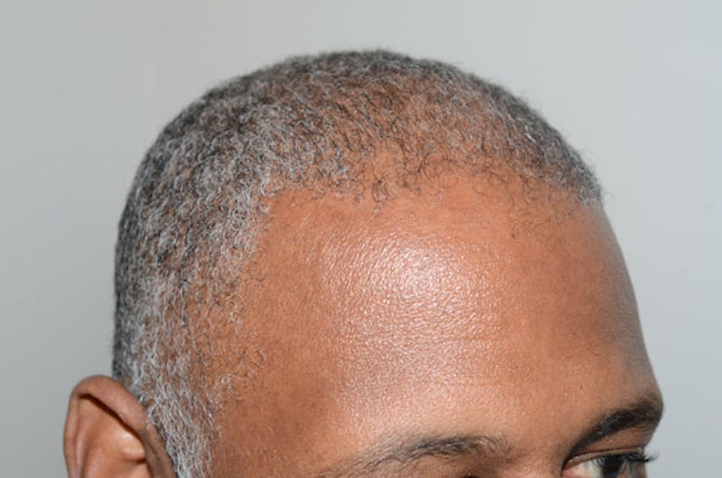 Hair Restoration for Men Before & After Gallery - Patient 239869 - Image 10