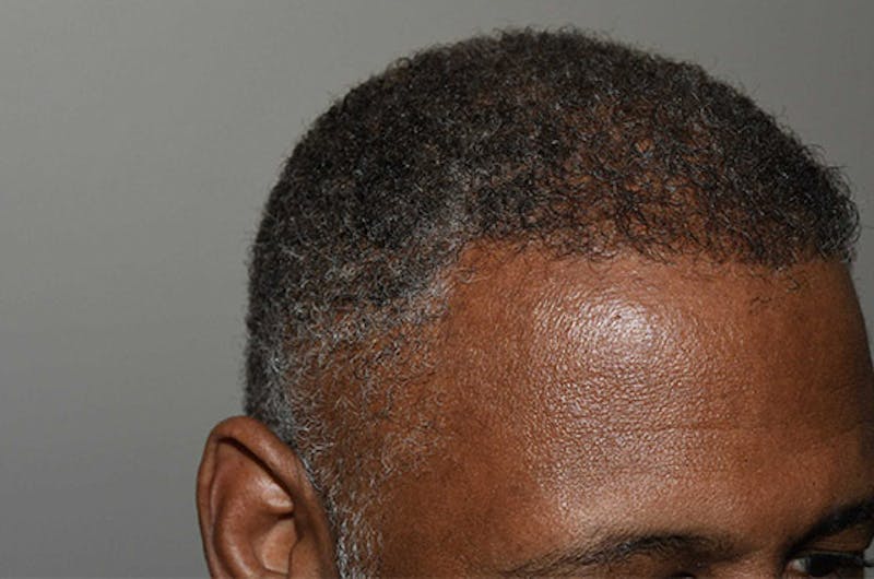 Hair Restoration for Men Before & After Gallery - Patient 790477 - Image 8