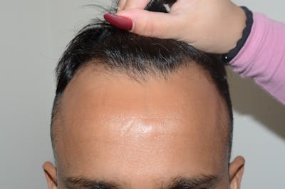 Hair Restoration for Men Before & After Gallery - Patient 756207 - Image 1