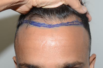Hair Restoration for Men Before & After Gallery - Patient 756207 - Image 2