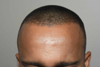 Hair Restoration for Men Before & After Gallery - Patient 756207 - Image 2
