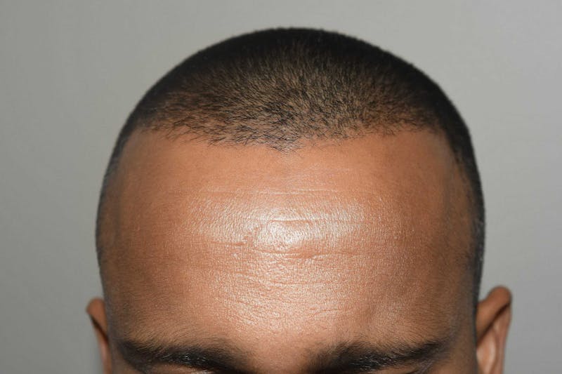 Hair Restoration for Men Before & After Gallery - Patient 422567 - Image 3