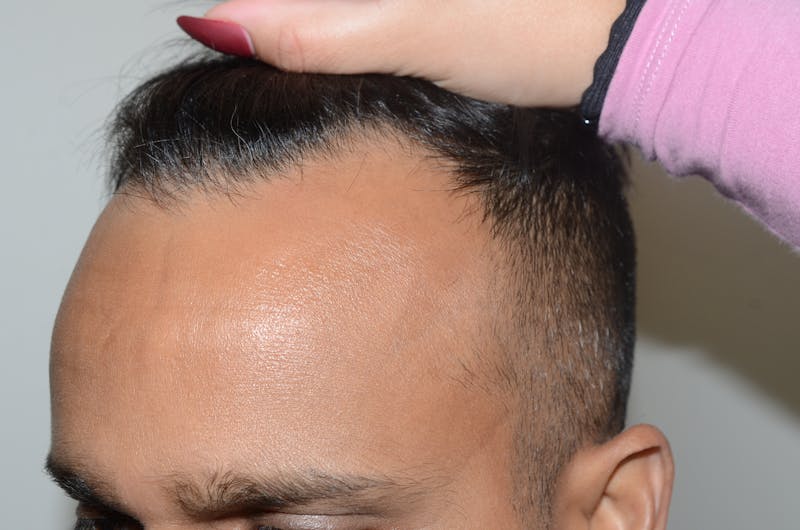 Hair Restoration for Men Before & After Gallery - Patient 422567 - Image 5